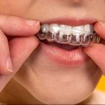 60642Las mejores marcas de implantes dentales en España