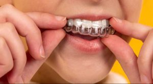 invisalign first opiniones