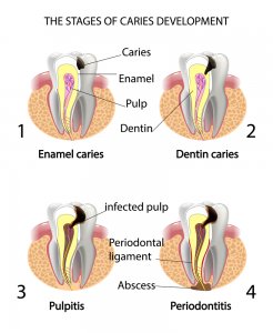 Got a dental abscess? Tooth infection symptoms, causes and treatments.