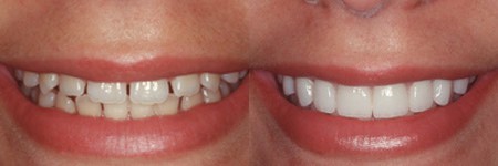 Can You Whiten Veneers? Teeth Whitening Tips For Veneers Tips - Dentaly.org