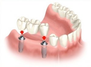 full dental implants