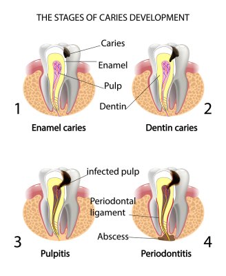 Tooth Abscess Guide: Dental Infection Symptoms and Treatment - Dentaly.org