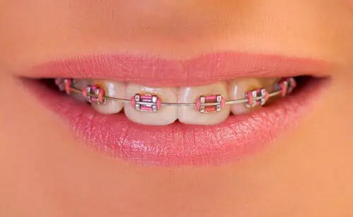 braces color wheel dark pink braces