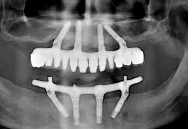 All-on-4 Dental Implants Cost, Process & Treatment Near You