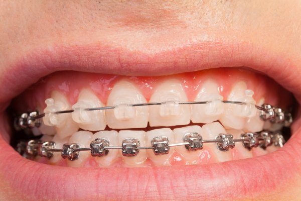 Ceramic Braces: What Do They Cost And Should You Get Them? - Dentaly.org