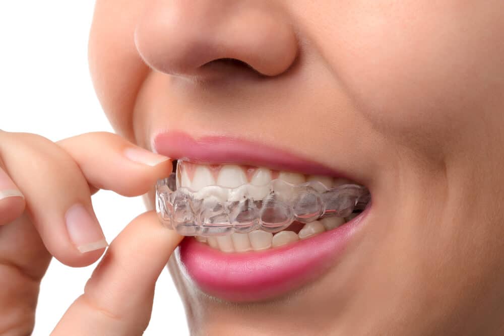 How Much Do Braces Cost for Adults and Teens? Find Out Now!