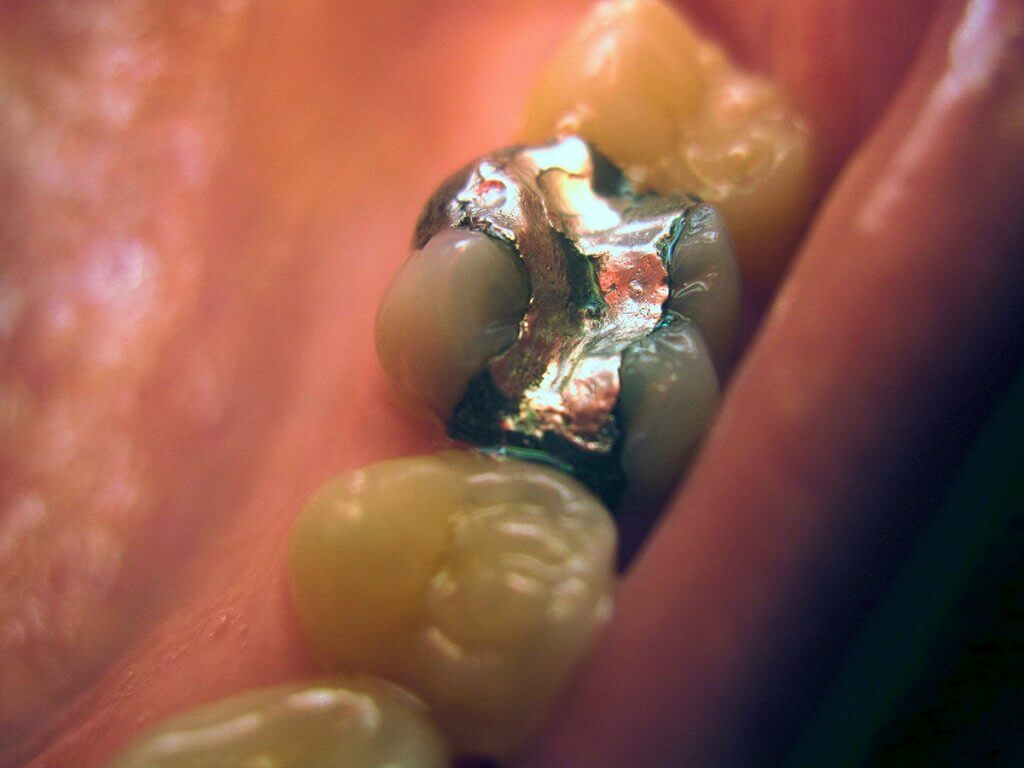 Amalgam vs. Composite Fillings Which is Best for You?