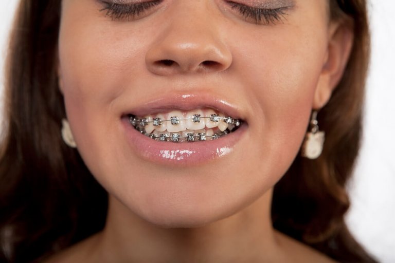 Crossbite in Adults & Kids Braces, Surgery & Costs