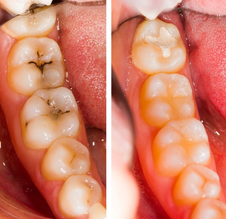 Filling Fell Out Fix And Prevent Lost Restorations Dentaly