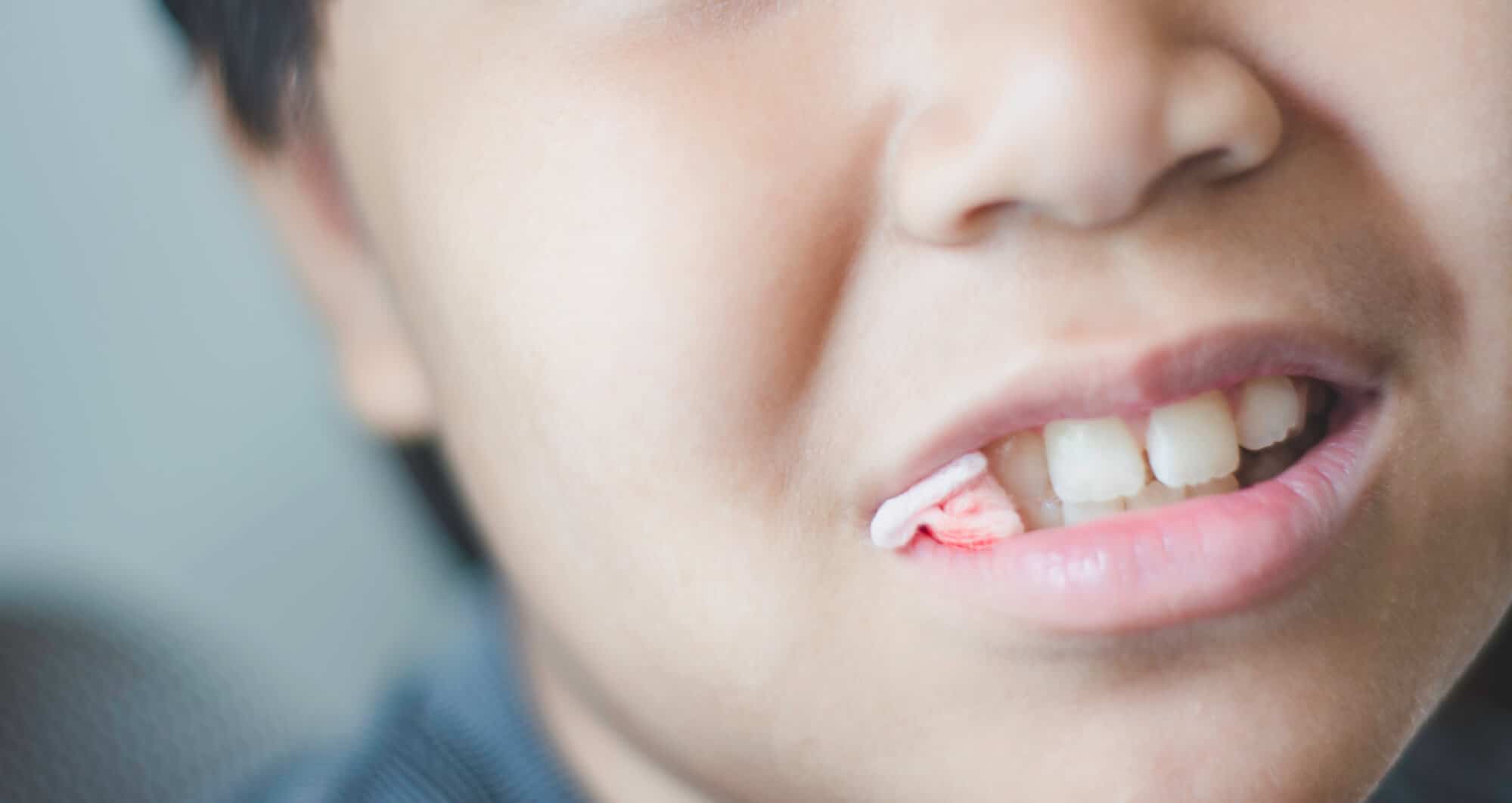 How Long Do I Keep Gauze in After a Tooth Extraction?