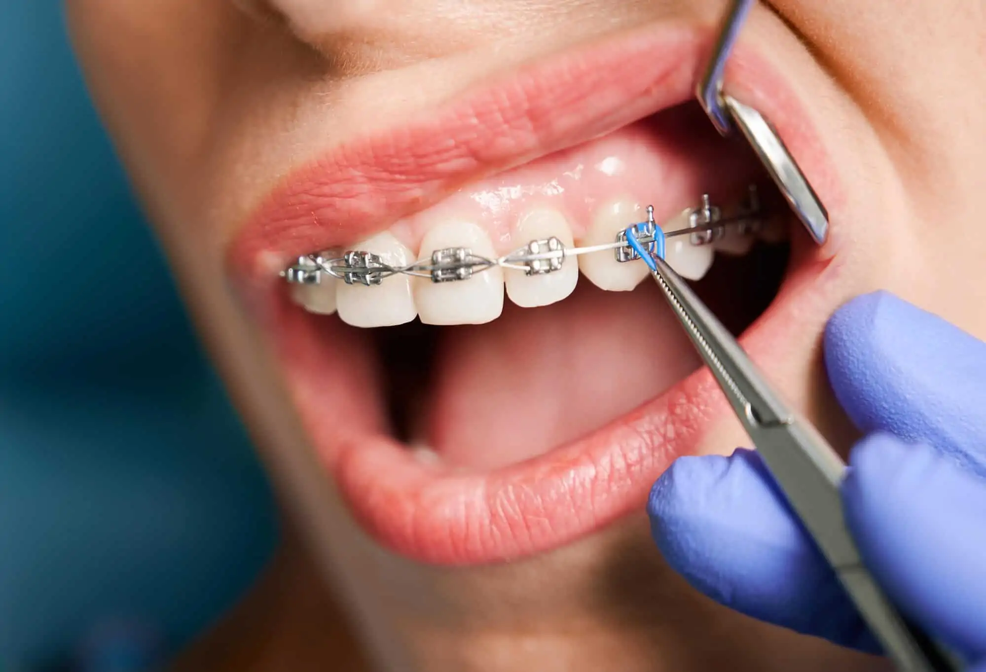 How Are Braces Tightened? Everything You Need to Know