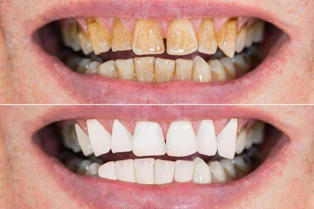 Does Coffee Stain Your Teeth Here S How To Prevent It