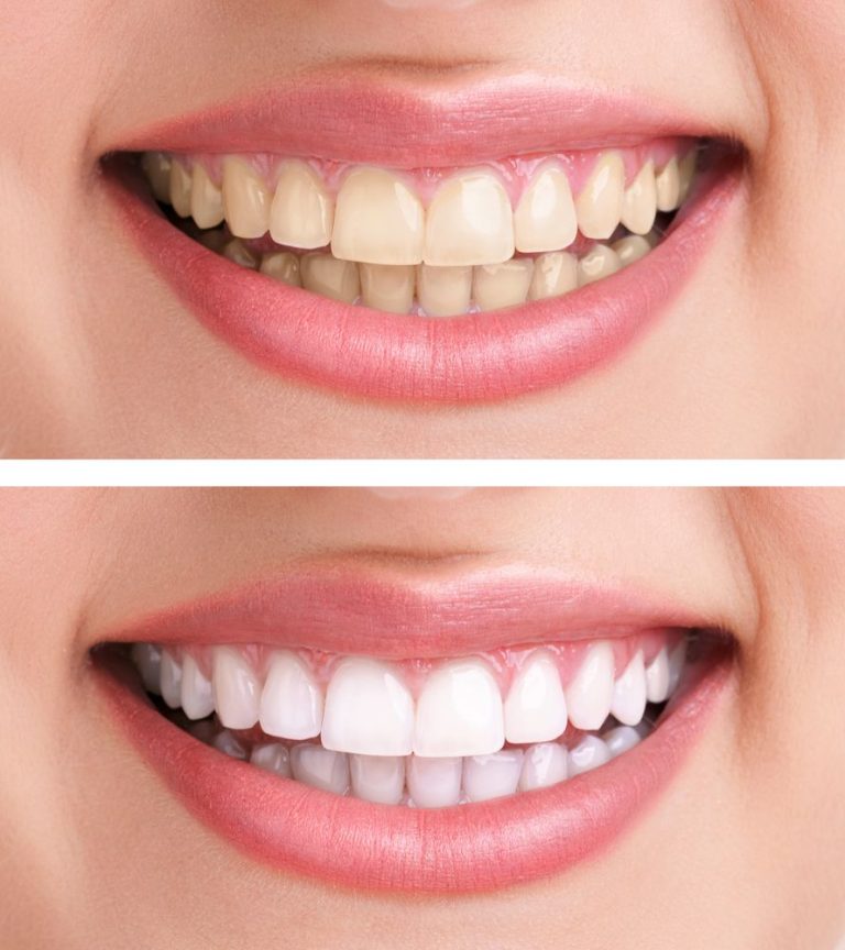 does-tea-stain-your-teeth-8-tricks-to-drink-tea-without-staining