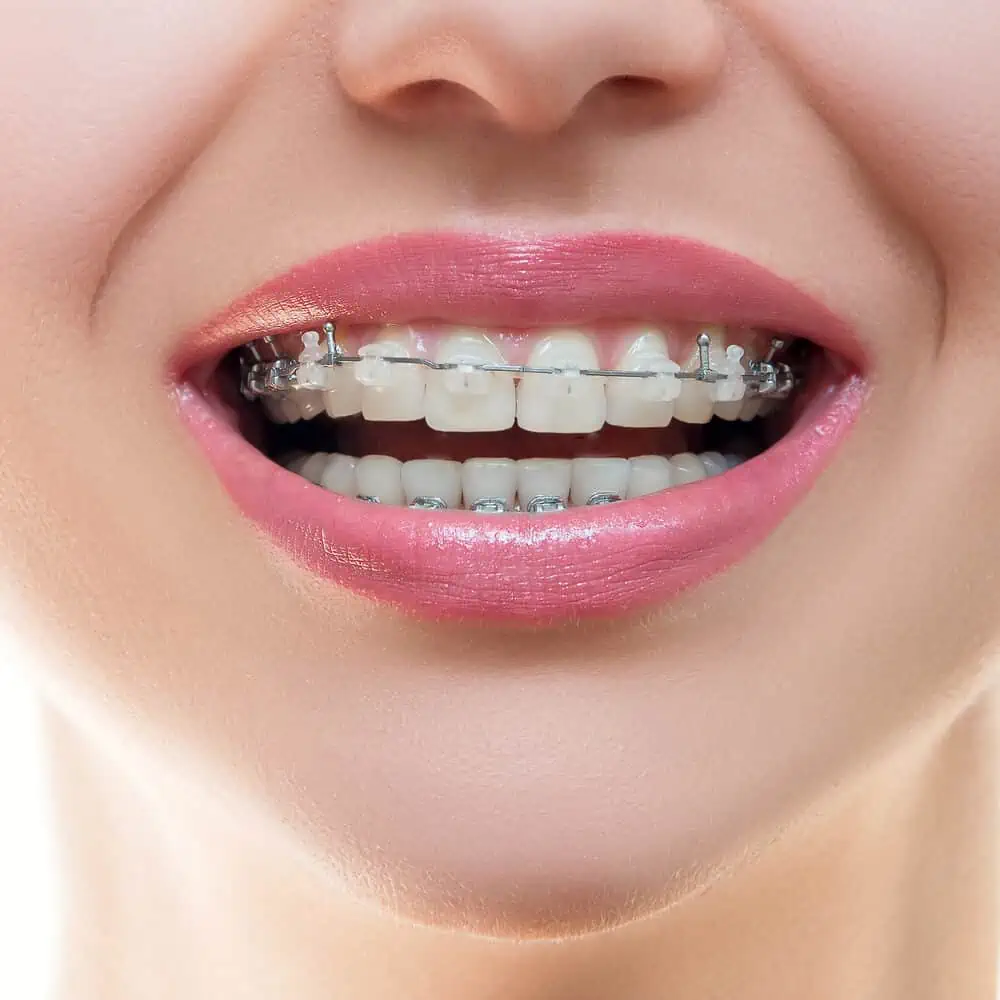 White Braces Different Types And Pros And Cons And Photos 