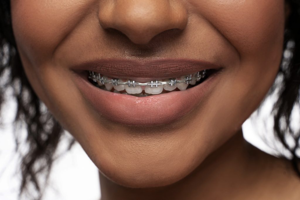 How to Get Free Braces for Adults ️ Medicaid 2024 - Dentaly.org