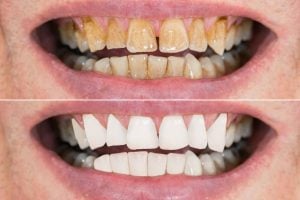 how to get rid of black stains on teeth