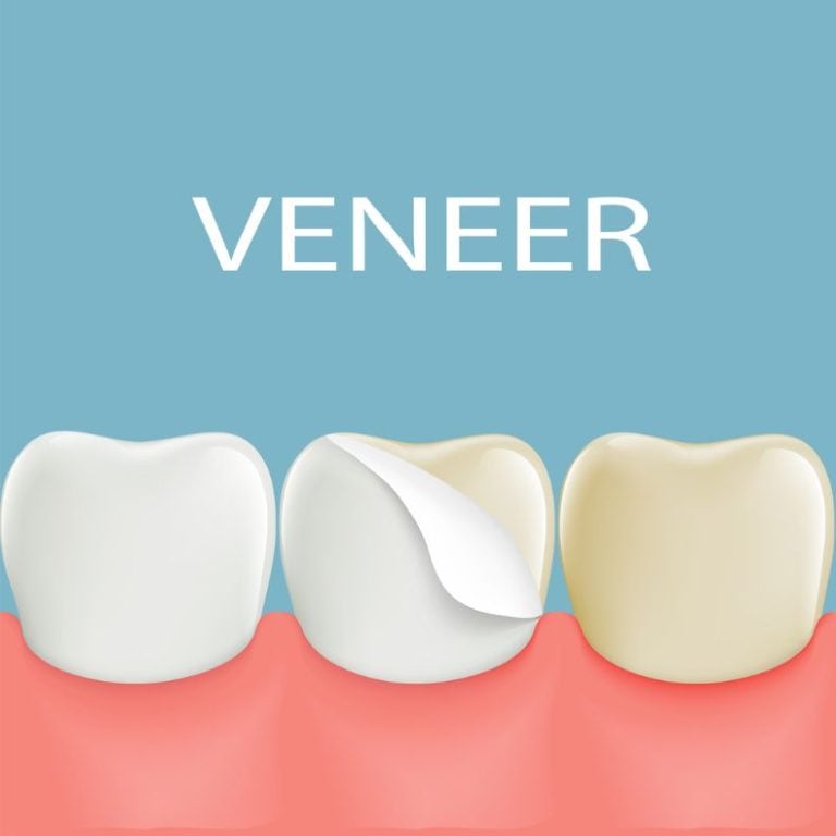 Dental Insurance that Covers Veneers Plans and Alternatives