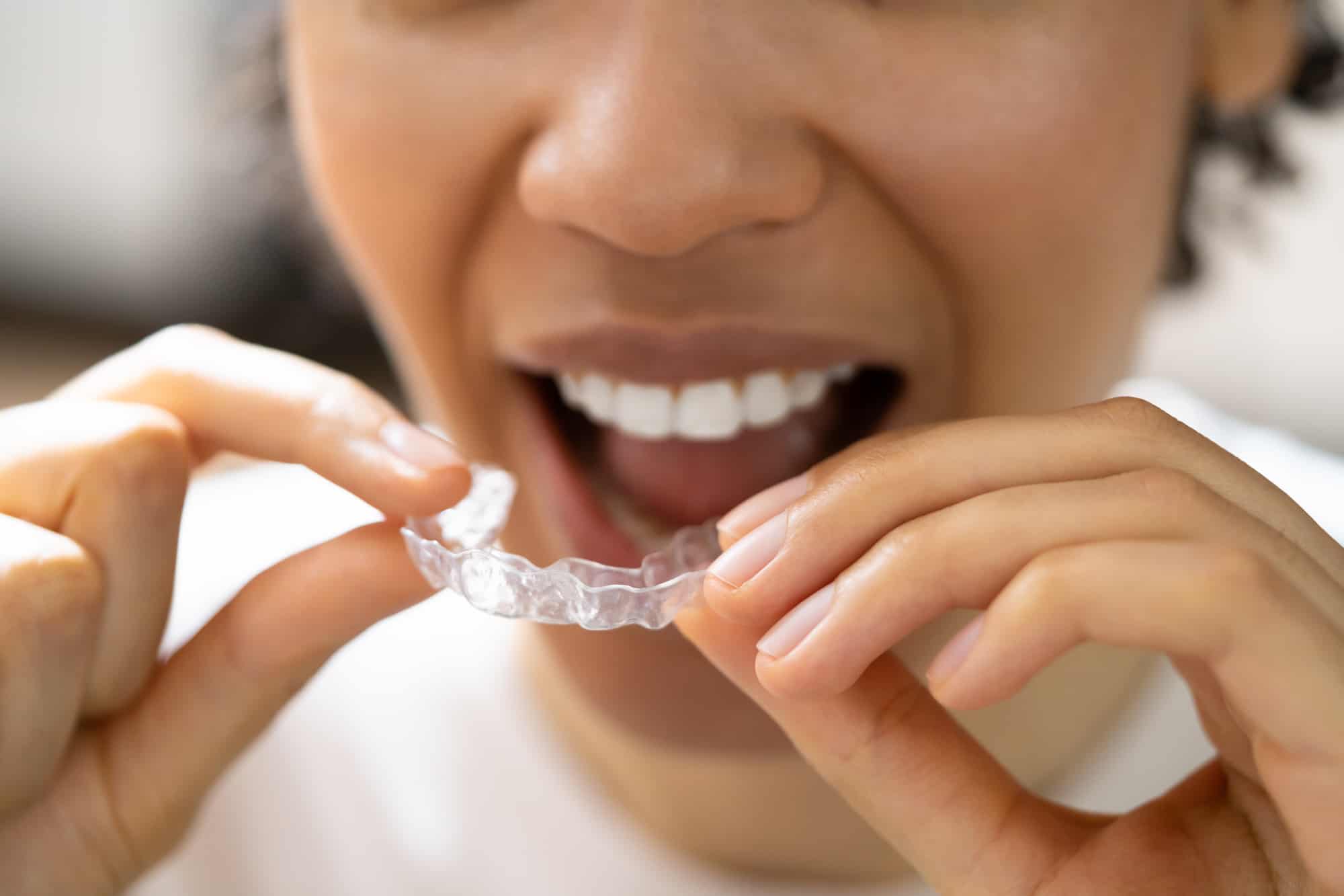 does-medicaid-cover-invisalign-and-other-treatment-funding-options