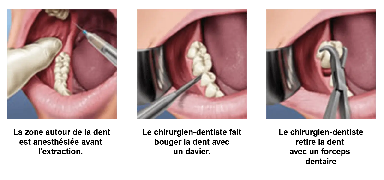 Extraction Dentaire Pourquoi Et Comment Arracher Une Dent