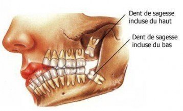 Tout Savoir Sur Les Dents De Sagesse Et Leur Extraction