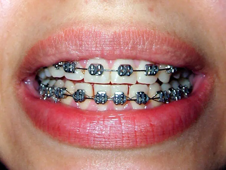 Appareil dentaire orthodontique : quel appareil dentaire choisir