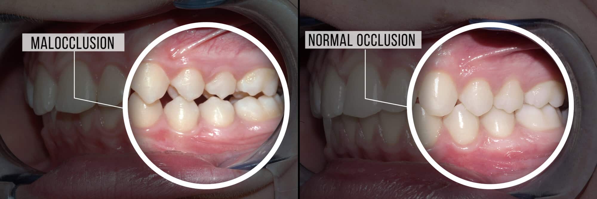 malocclusion-dentaire-types-et-solutions-dentaly