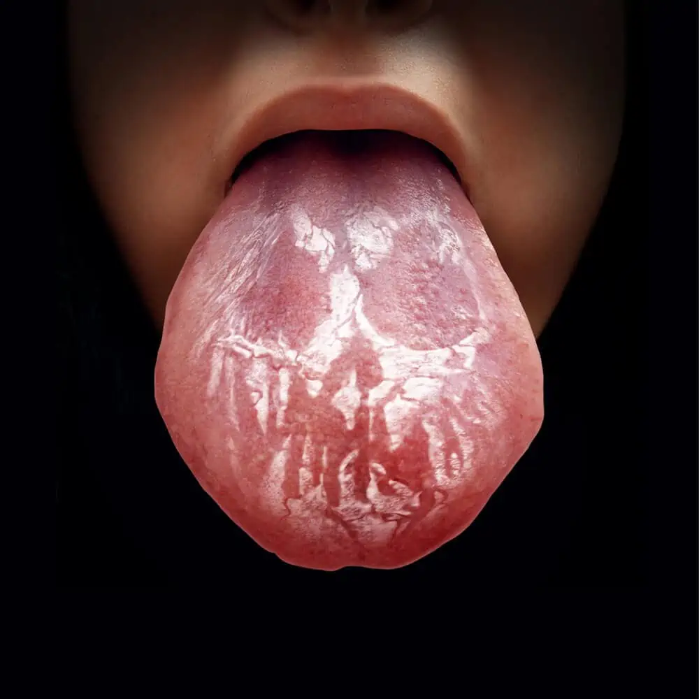 List 102+ Pictures photos of oral thrush Updated