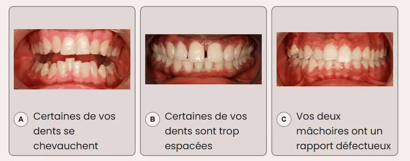 Test du sourire Aligneurs Français